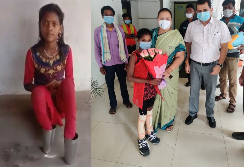 दिव्यांग गीता अब अपनी पैरों पर हुईं खड़ी, मंत्री अनिला भेंड़िया ने दिया कृत्रिम पैर