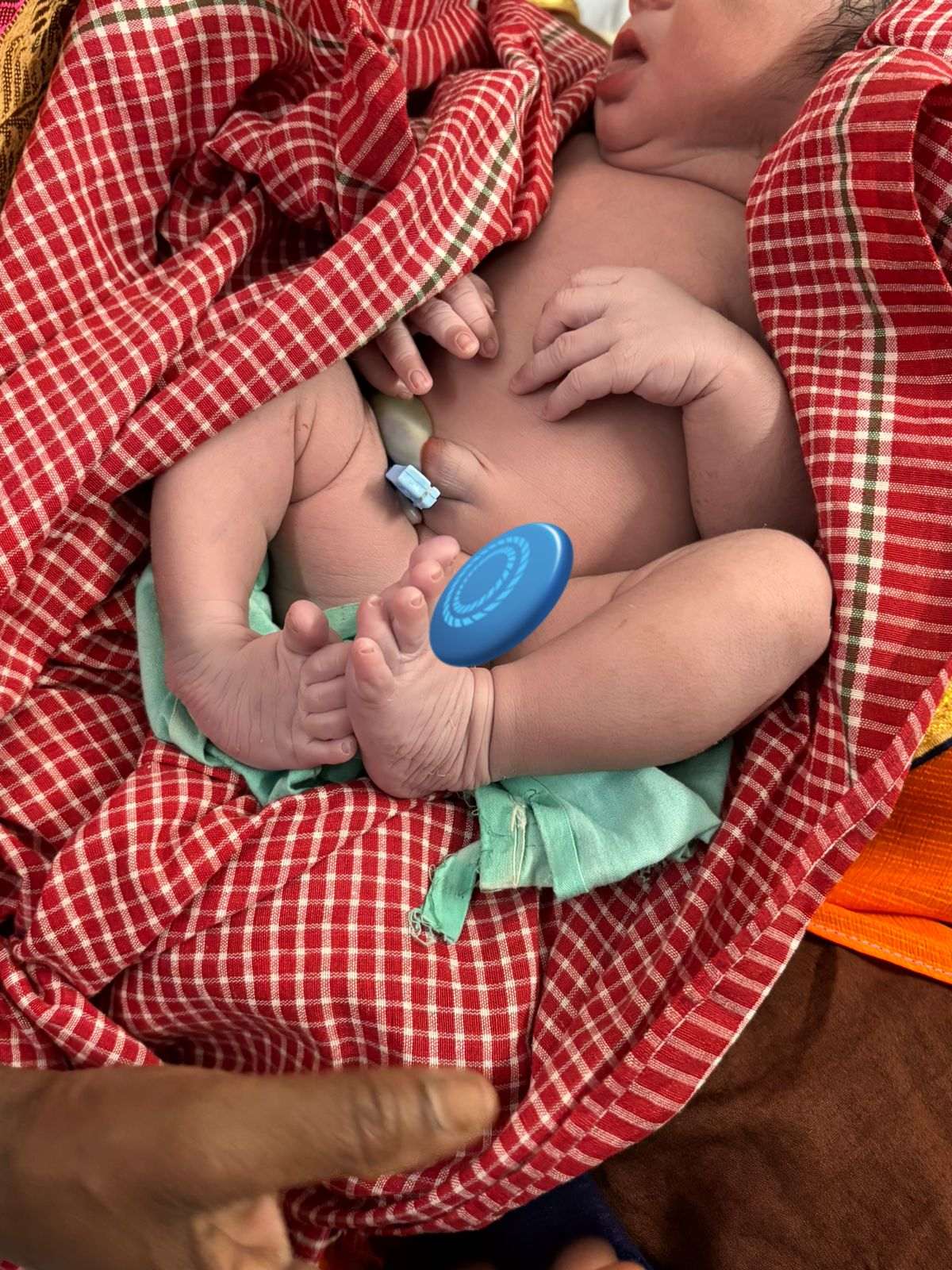 नवजात शिशु में क्लब फुट की पहचान